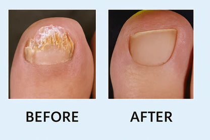 Bee Venom Nail Fungus