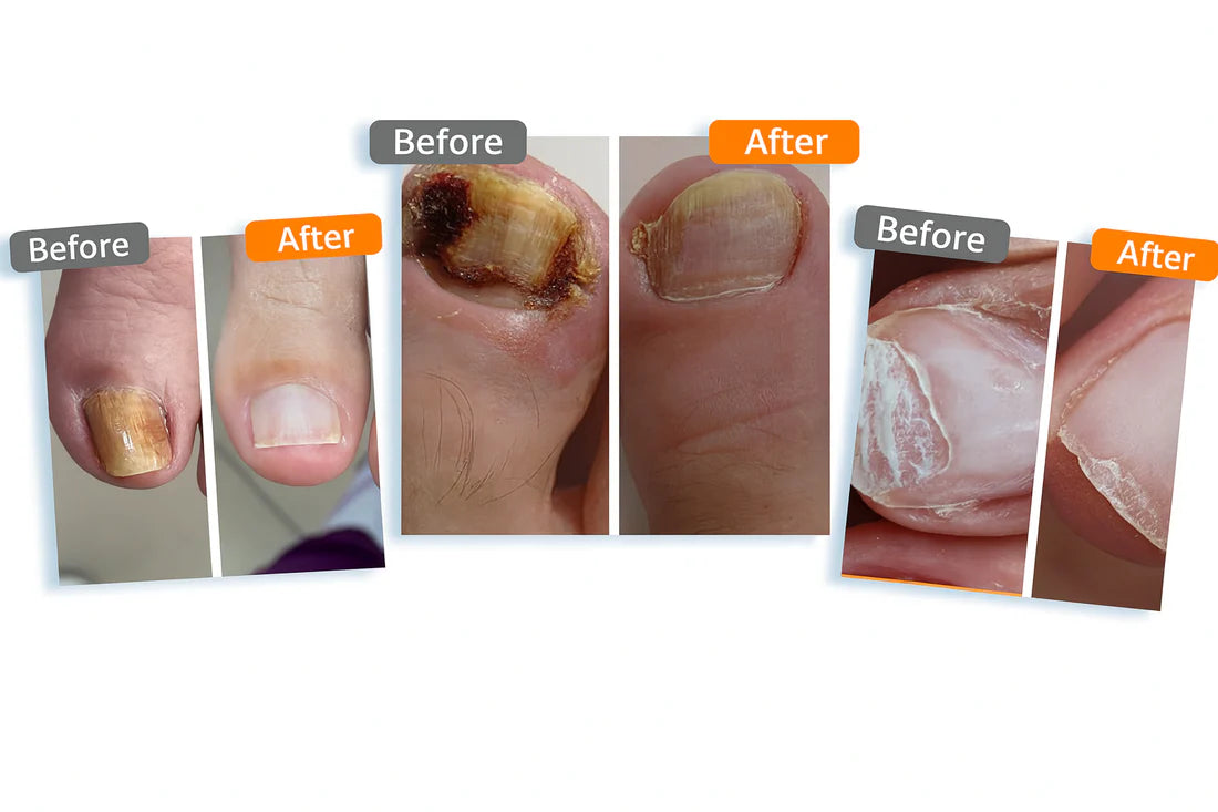 Bee Venom Nail Fungus