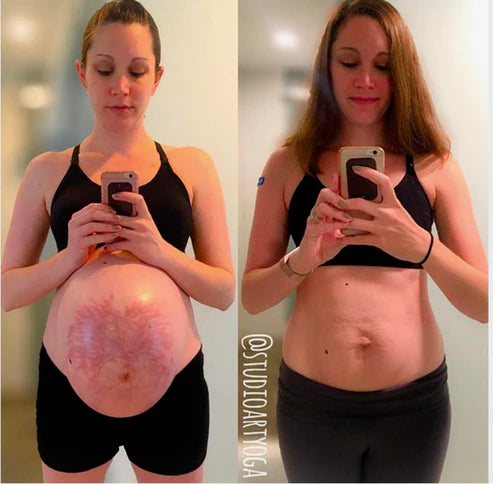 DermaLuv™ - Anti wrinkle/Stretch Marks Patch