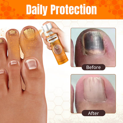 Bee Venom Nail Fungus