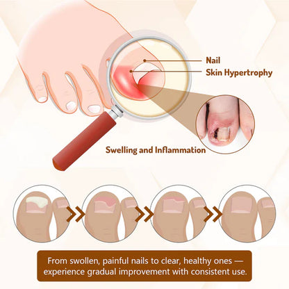 Bee Venom Nail Fungus