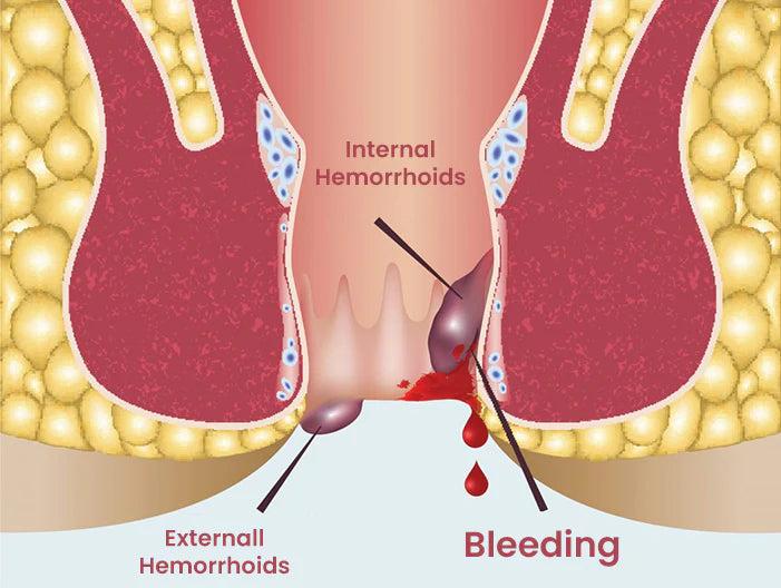 Cvreoz Hemorrhoid Spray